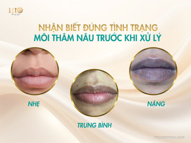 Cách khắc phục môi thâm nâu hiệu quả nhất 2026 3 Nhận biết 3 mức độ môi thâm nâu trước khi xử lý