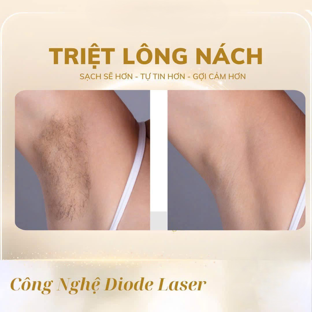 Hình ảnh kết quả triệt lông nách sạch sẽ và mịn màng sau khi điều trị bằng công nghệ laser tại Rio