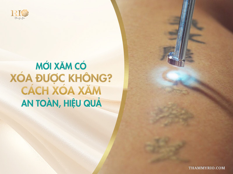 Xăm có xóa được không? Mới xăm có xóa được không? Xóa xăm an toàn bằng Laser.