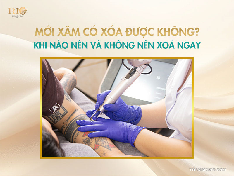 3 Mới xăm có xóa được không? Khi nào nên và không nên xoá