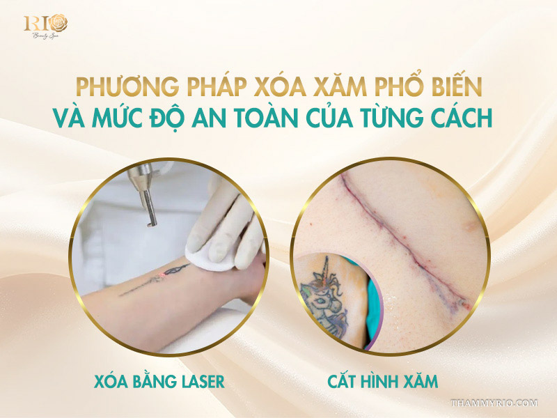 6 So sánh các cách xóa xăm an toàn: Xóa xăm bằng laser có hại không?