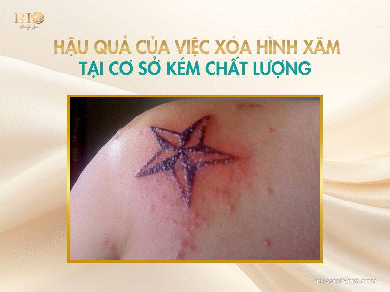 7 Cảnh báo hậu quả của việc xóa hình xăm không an toàn