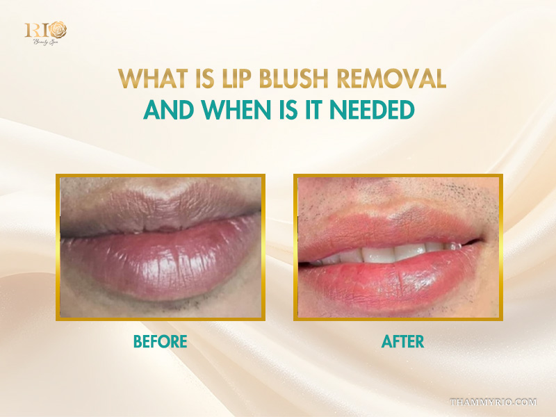 Before and after results of lip blush removal treatment for dark and uneven lip pigment.