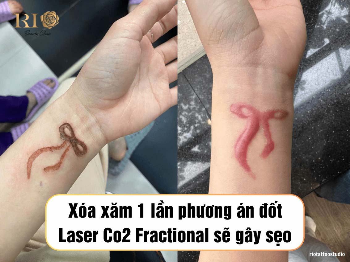 Xóa xăm 23 Hình ảnh so sánh kết quả xóa xăm hỏng gây sẹo lồi tại cơ sở không uy tín và xóa xăm thẩm mỹ an toàn bằng Laser tại Rio Beauty Clinic.