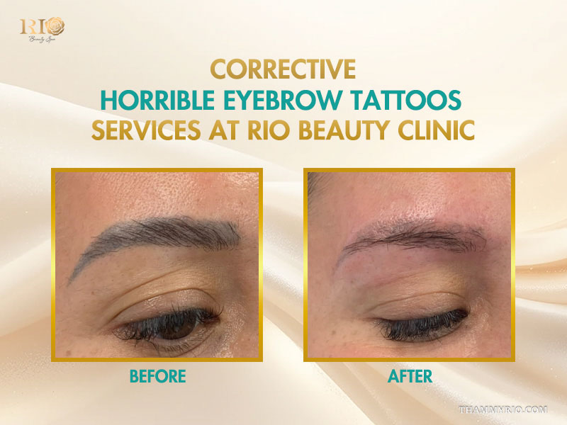 Before and after of corrective laser removal for horrible eyebrow tattoos at Rio Beauty Clinic.
