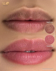 Before and after healed results of lip blushing on dark lips showing smooth texture and pink pigment.