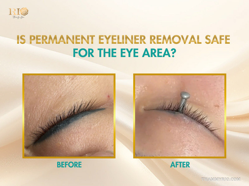 Before and after comparison of removing permanent eyeliner safely with protective eye shields.