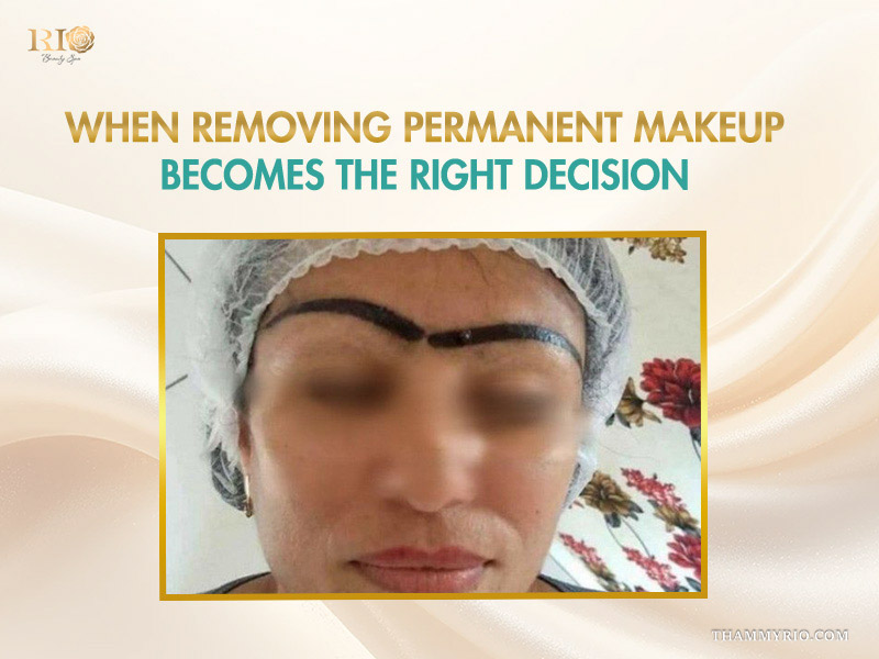 Close-up of botched eyebrow tattoo showing why removing permanent makeup is necessary.