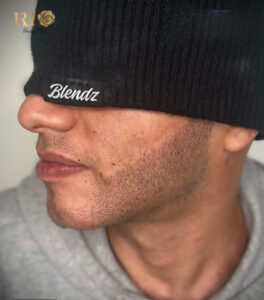 Khách hàng nước ngoài tin tưởng lựa chọn dịch vụ xăm chân râu tại Thẩm Mỹ Rio Việt Nam