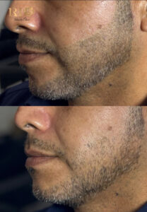 Khắc phục tình trạng râu thưa mọc không đều và nham nhở bằng kỹ thuật xăm chân râu tại Rio