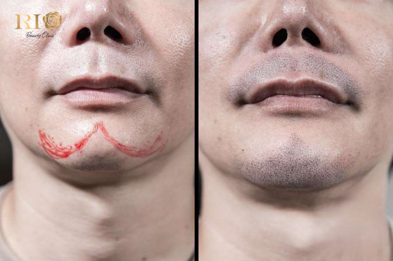 Khách hàng hài lòng tuyệt đối với kết quả xăm chân râu tự nhiên tại Thẩm Mỹ Rio