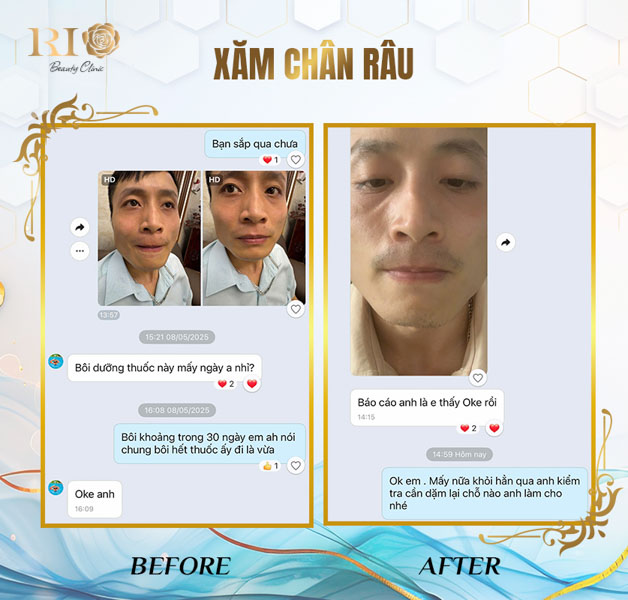 So sánh trước và sau khi xăm chân râu - Khách hàng lột xác nam tính tại Thẩm Mỹ Rio