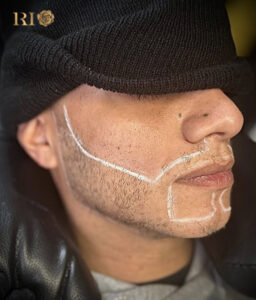 Quy trình xăm râu các bước phác thảo và thực hiện cần được chuyên gia giàu kinh nghiệm tránh những sai lầm bởi thực hiện trên khuôn mặt rất quan trọng