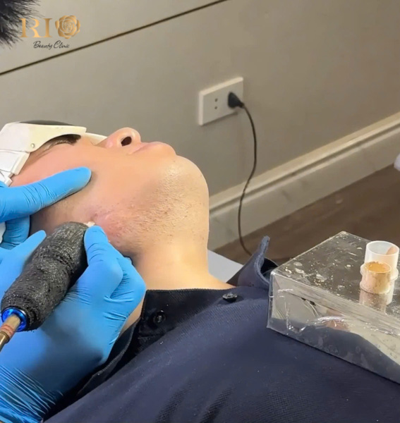 Xăm chân râu che sẹo ở cằm và khắc phục râu thưa thớt tại Thẩm Mỹ Rio