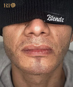 Khách hàng từ Pháp tin tưởng xăm râu quai nón tại Thẩm Mỹ Rio Việt Nam