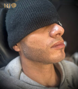 Đạo diễn người Pháp David Villa xăm râu quai nón tại Thẩm Mỹ Rio và vô cùng hài lòng