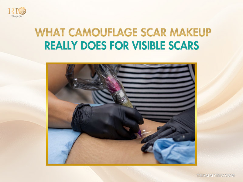 Professional camouflage scar makeup procedure using medical-grade tattooing to conceal stretch marks on skin.