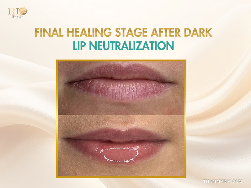 Final results of dark lip neutralization healing process showing before and after pinkish lip transformation.