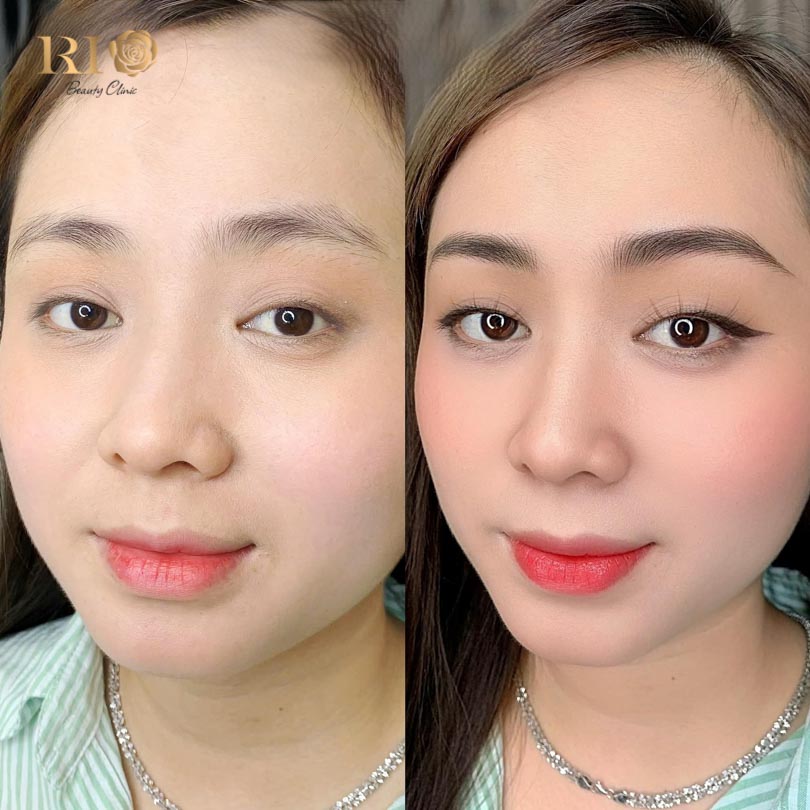 International client arriving at Rio Beauty Clinic for a masterful eyebrow feathering tattoo.