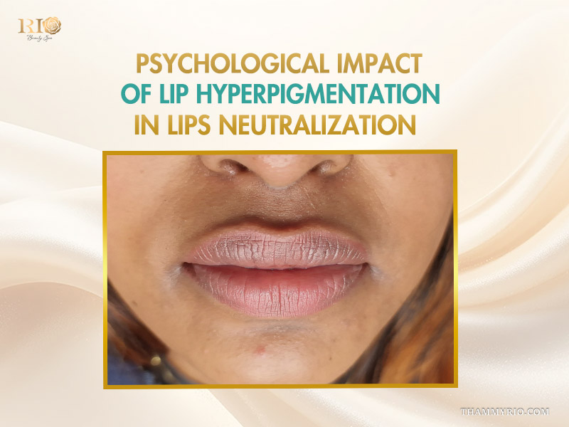 Psychological impact of lip hyperpigmentation shown on a before and after image from a lip neutralization treatment at rio beauty spa.