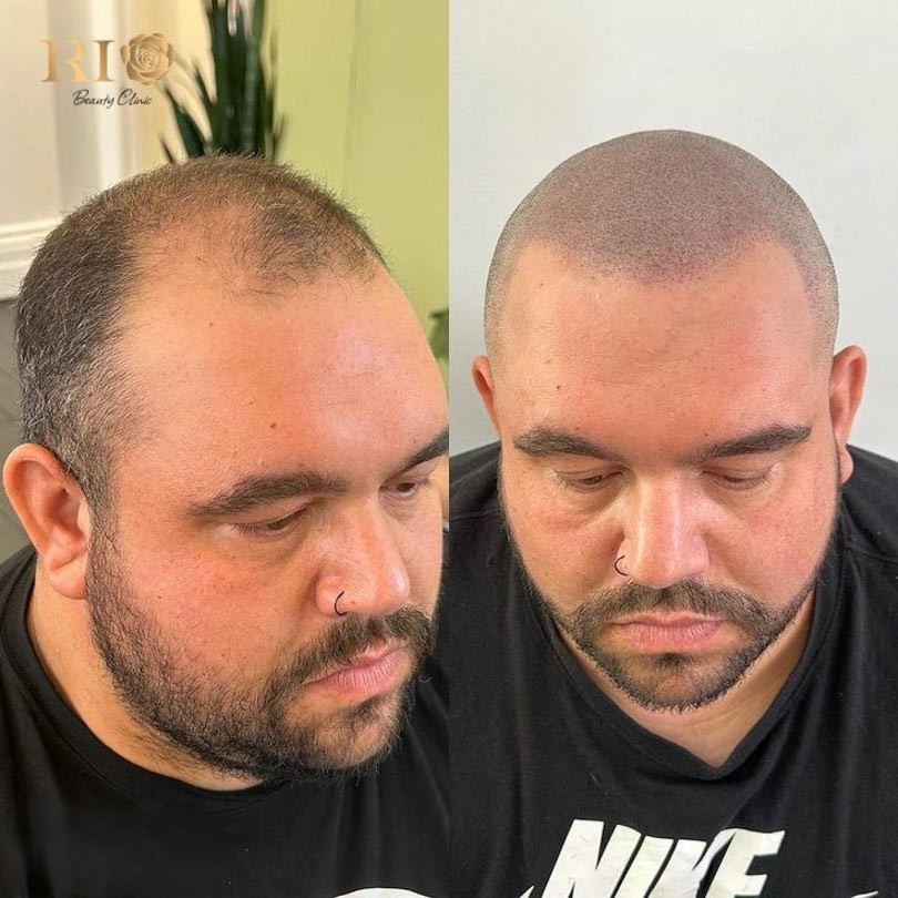 Technique of layering ink for density and texture in microblading on scalp procedures at Rio Clinic