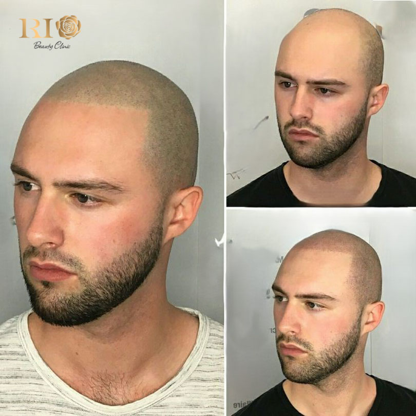 Non-surgical solutions for addressing receding hairlines and frontal baldness at Rio Clinic
