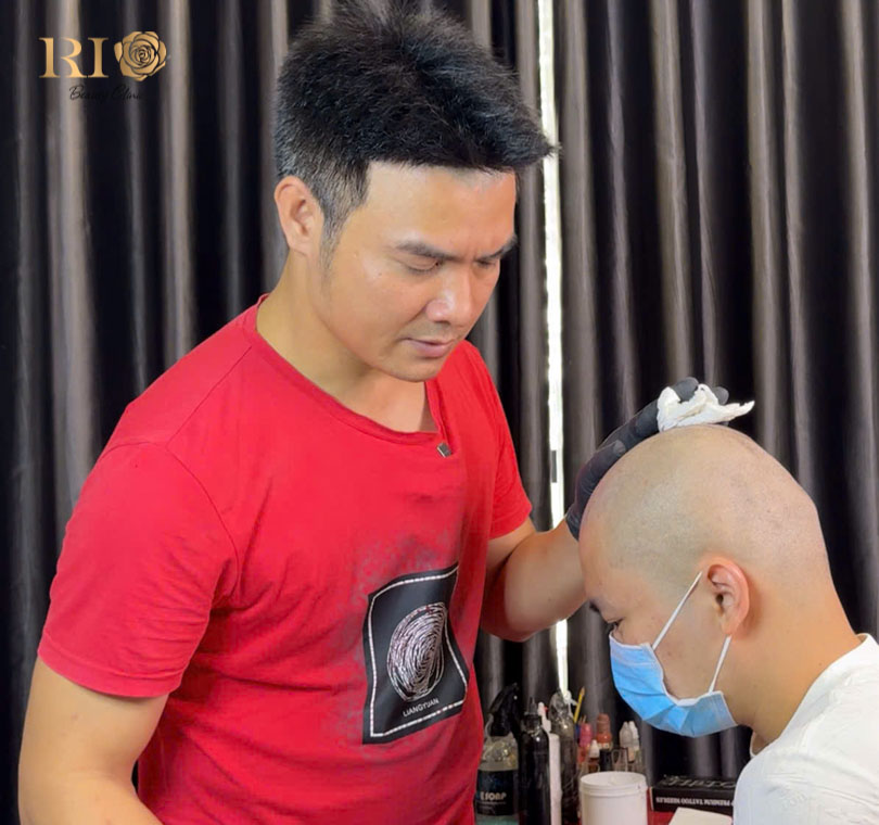 Initial consultation and hairline design mapping for microblading on scalp procedures at Rio Clinic