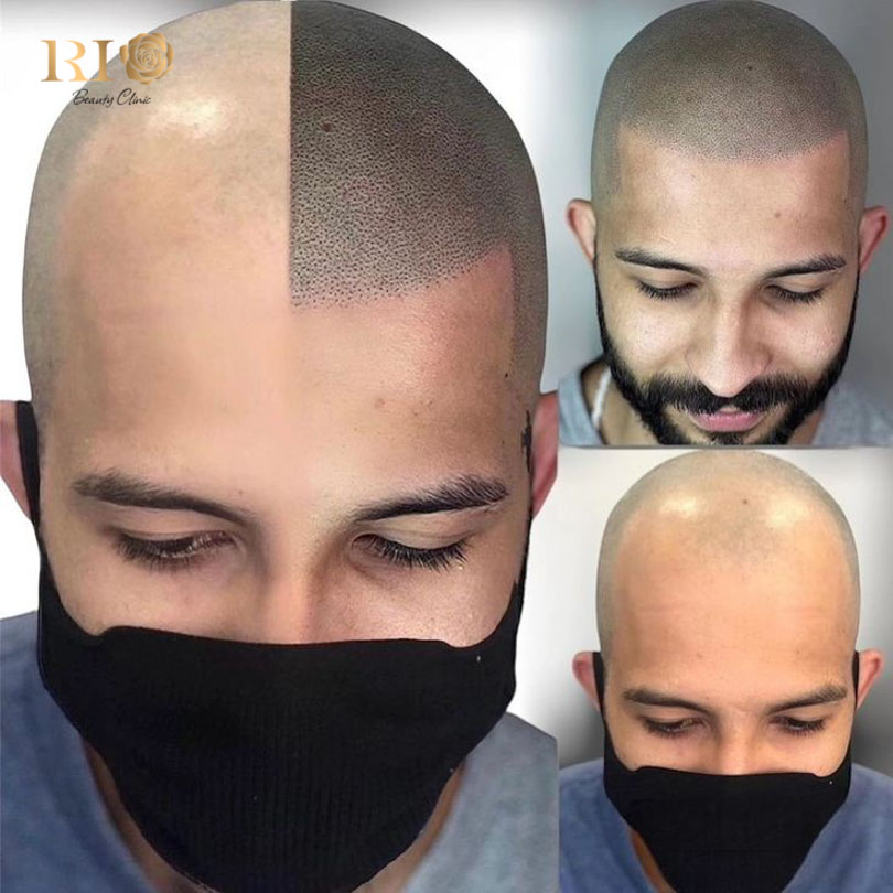 Expert tips on protecting microblading the scalp pigment from sun exposure and sweat at Rio Clinic