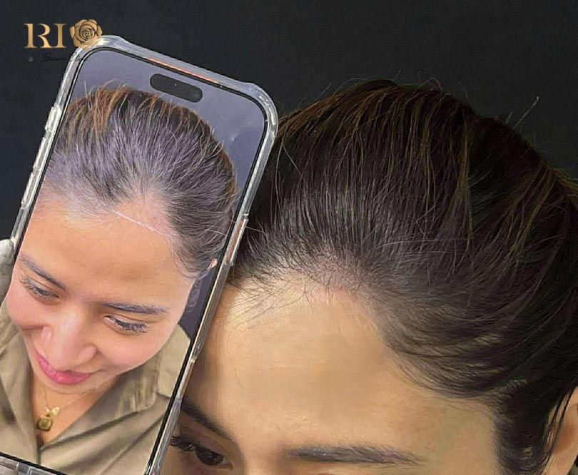 Microblading the scalp solutions for women suffering from traction alopecia at Rio Beauty Clinic