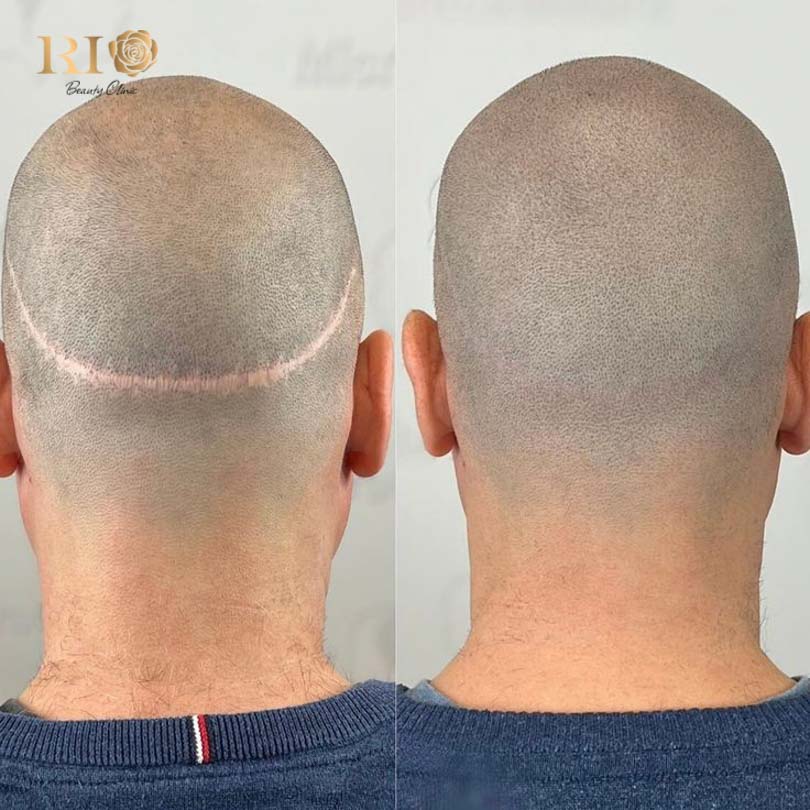 Expertise in camouflaging surgical scars and trauma marks with microblading on scalp techniques at Rio.