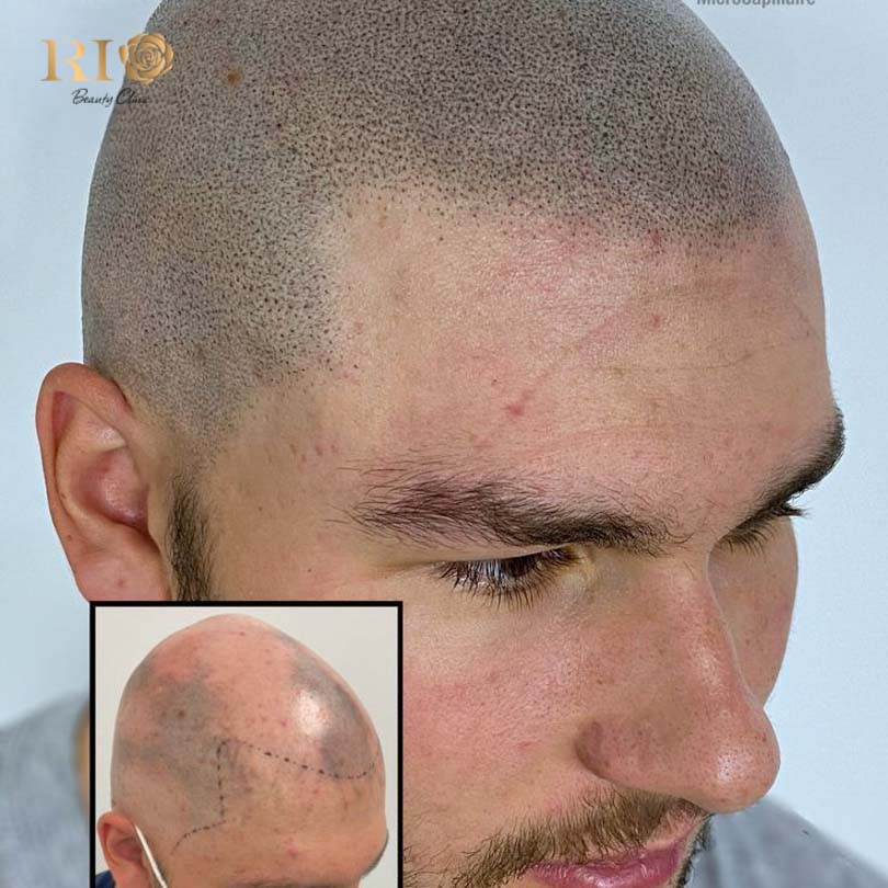 Longevity variances between microblading the scalp and SMP dotting techniques for hair density