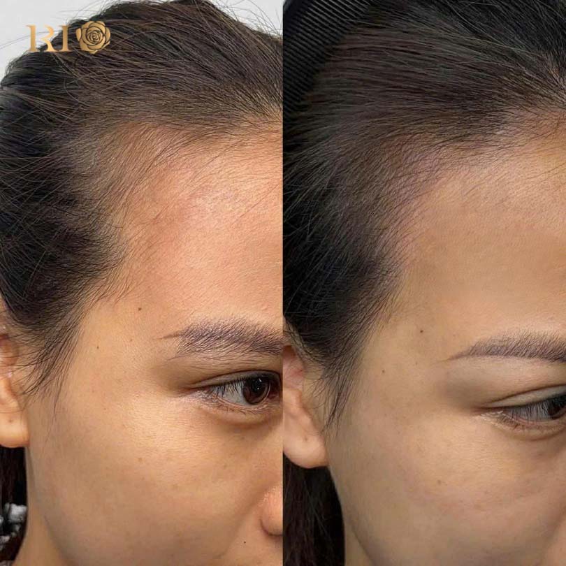 Longevity comparison between SMP and microblading the scalp for hair density