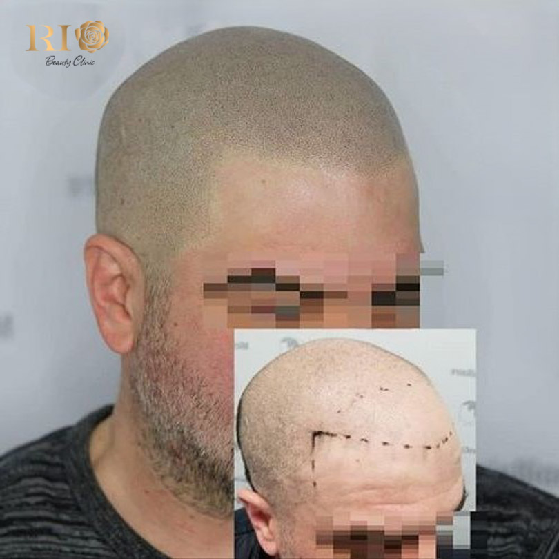 Guide to choosing the right method for your specific hair type: Microblading the scalp vs SMP at Rio