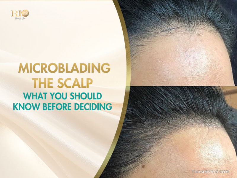 Before and after results showing natural hair density restoration with microblading the scalp at Rio Beauty Clinic