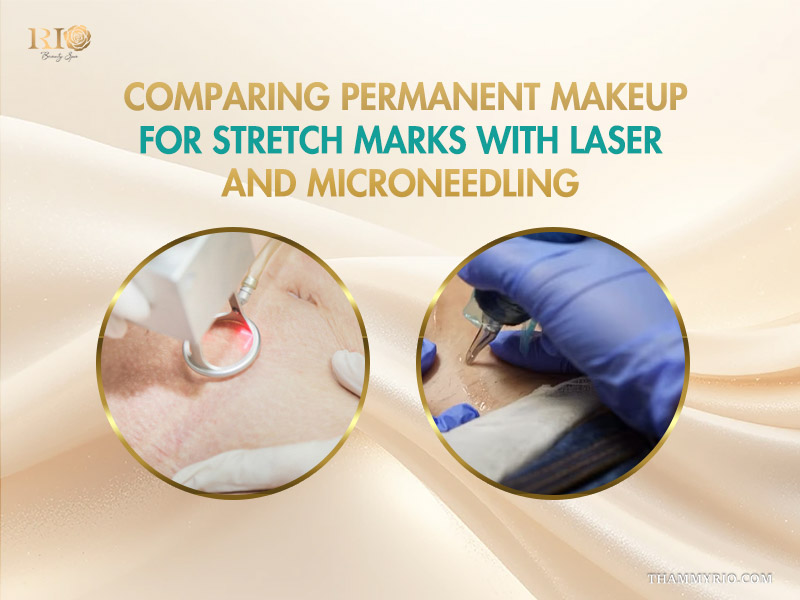 Comparison of permanent makeup for stretch marks vs laser and microneedling treatments.