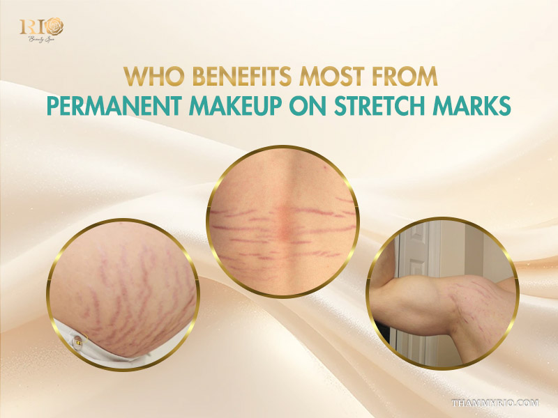 Comparison of different body areas showing who benefits from permanent makeup for stretch marks.