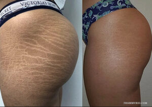 Scar camouflage tattoo dark skin that actually blends 2 - Thẩm Mỹ Rio Beauty Clinic