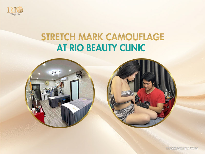 A composite image for Rio Beauty Clinic showing a clean procedure room and a tattoo artist performing a scar camouflage tattoo on the abdomen of a client, relevant for scar camouflage tattoo dark skin treatments.