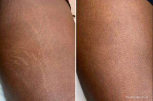 Stretch marks on dark skin before and after camouflage tattoo treatment