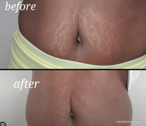 Scar camouflage tattoo dark skin that actually blends 1 - Thẩm Mỹ Rio Beauty Clinic