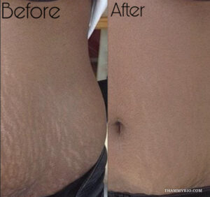 Scar camouflage tattoo dark skin that actually blends 3 - Thẩm Mỹ Rio Beauty Clinic