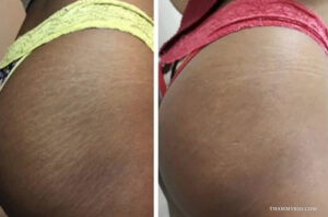 Scar camouflage tattoo dark skin that actually blends - Thẩm Mỹ Rio Beauty Clinic