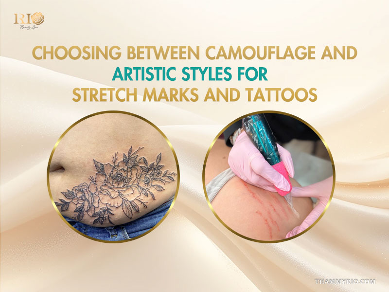 A comparison between artistic floral stretch marks and tattoos camouflage versus medical style micro-needling.