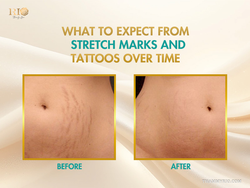 Before and after comparison of stretch marks and tattoos camouflage results over time on the abdomen.