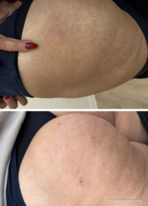 Before and after comparison of stretch marks tattoo cover up using skin-colored camouflage ink on hips.