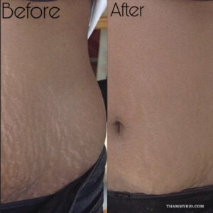 Before and after comparison of a stretch marks tattoo cover up on the abdomen using skin color camouflage technique.