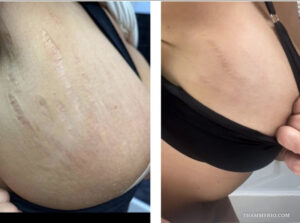 Before and after comparison of stretch marks tattoo cover up treatment on breast area.