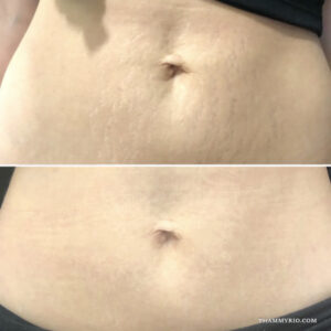 Before and after comparison of stretch marks tattoo cover up on the abdomen showing significant skin tone blending.