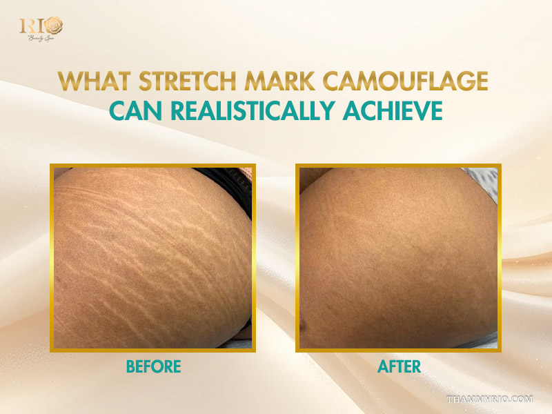 Before and after comparison of stretch marks tattoo cover up on dark skin.