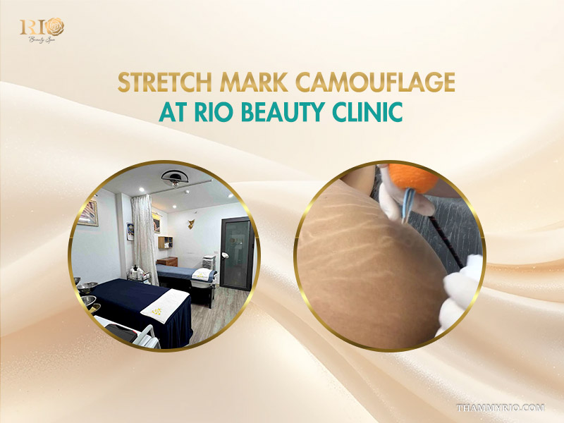 Professional stretch marks tattoo cover up procedure at Rio Beauty Clinic.